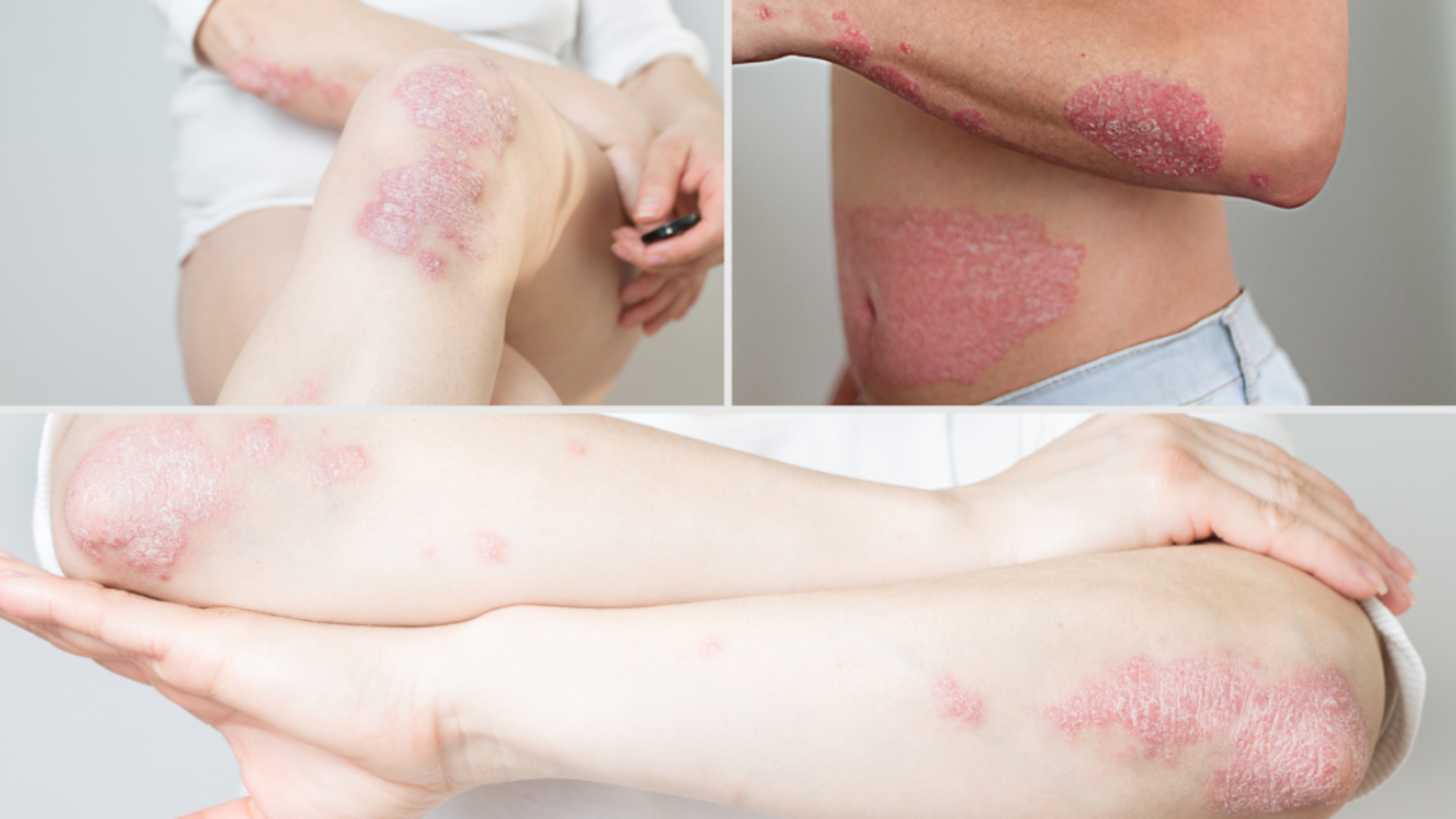 ¿De dónde viene la psoriasis