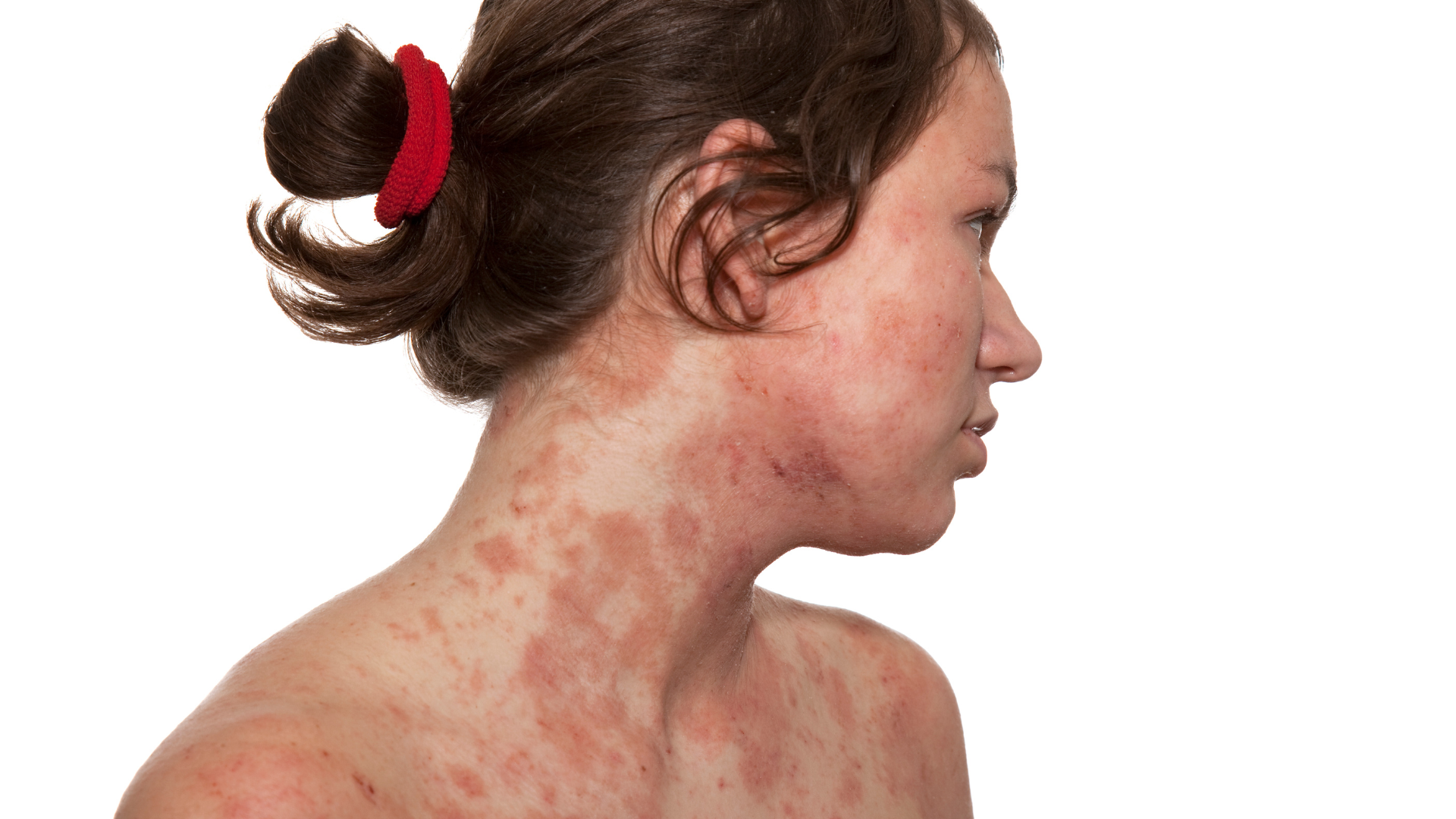 Dermatitis: Tipos, Síntomas y Tratamientos